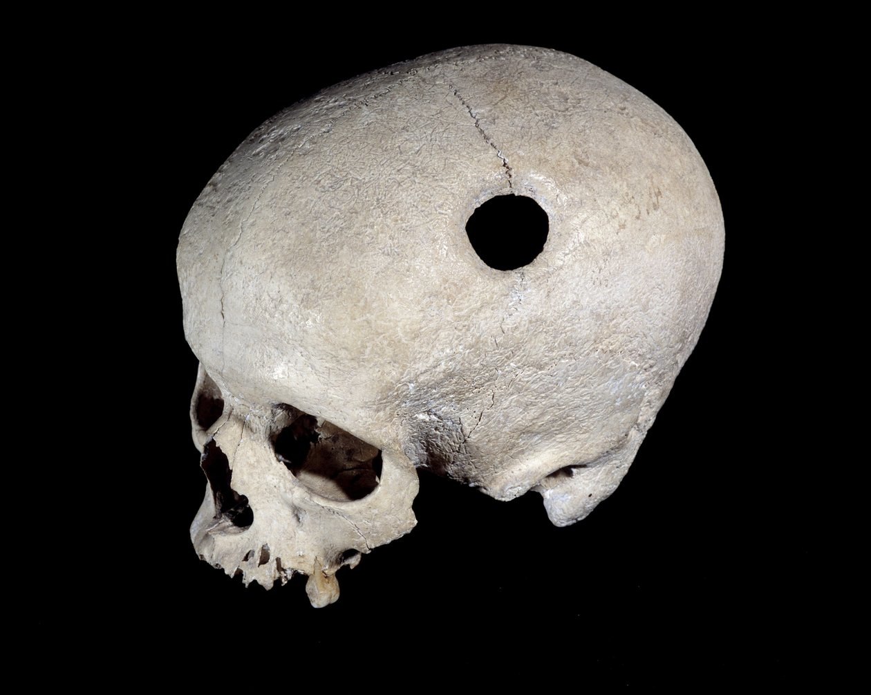 Trepanasyon izi olan tarih öncesi kafatası, Ulusal Eski Eserler Müzesi. by Prehistoric Prehistoric