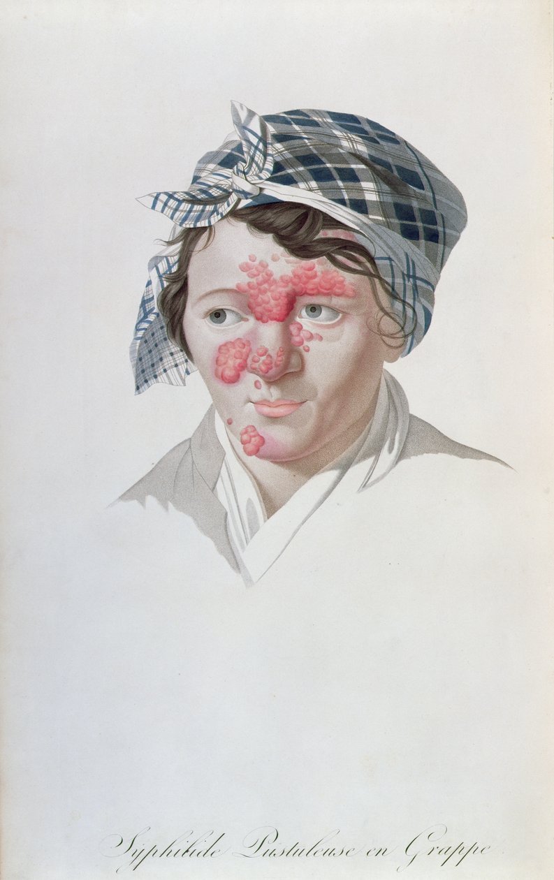 Sifilik küme püstülleri, Baron Jean Louis Alibert