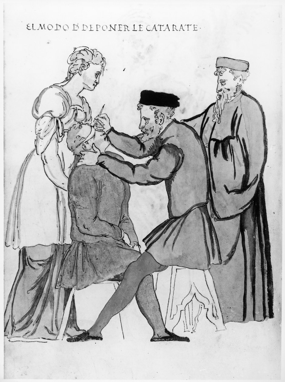 Kataraktları gidermek için göz ameliyatı (kağıt üzerinde kalem ve mürekkep) by Spanish School