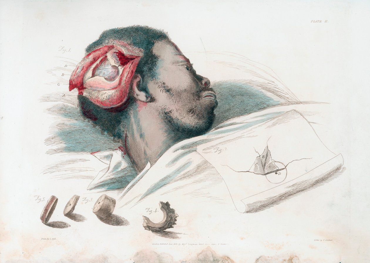 Trepanasyon sonrası kafatasındaki yaranın görünümü ve sol altta parçalanmış kemik parçasının çıkarılması, 1821 by Thomas Landseer