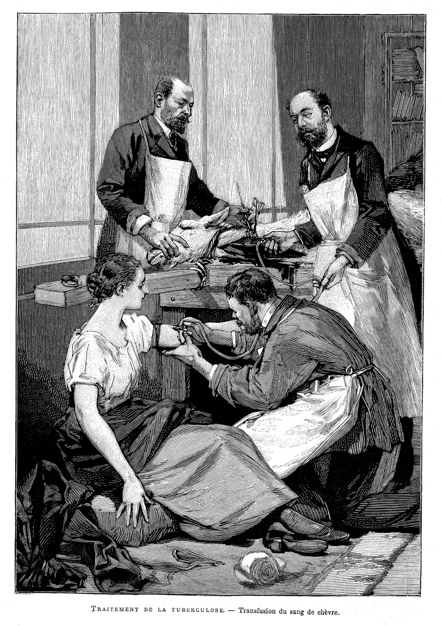Keçi kanının transfüzyonu yapılan bir tüberküloz hastası, 1891 by Unbekannt