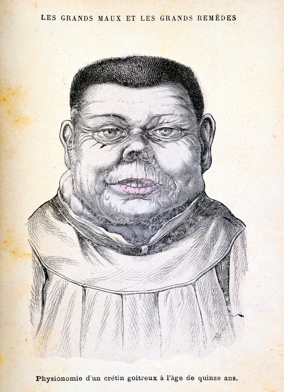 Cretin, 15 yaşında, c1890 by Unbekannt
