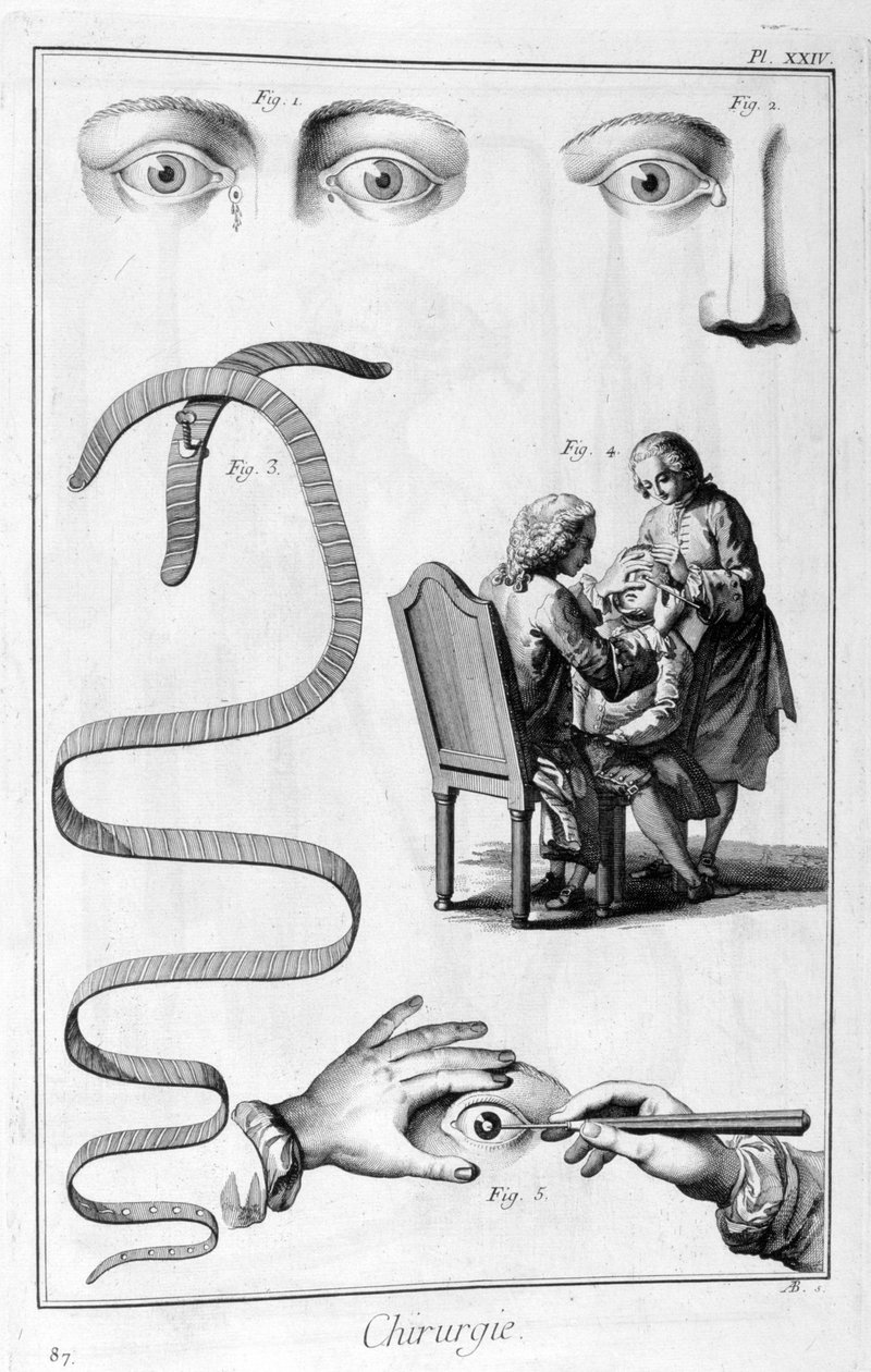 Göz ameliyatı, 1751-1777 by Unbekannt