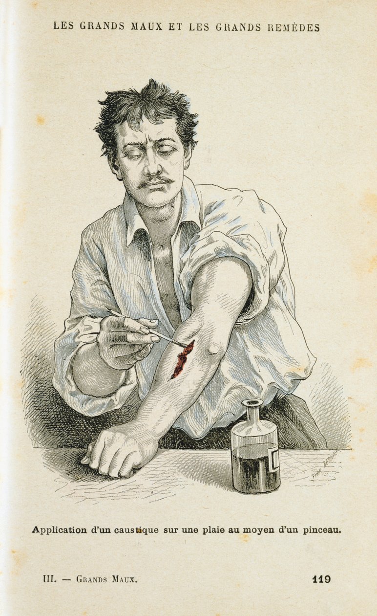Bir yarayı antiseptik solüsyonla boyamak, c1890 by Unbekannt