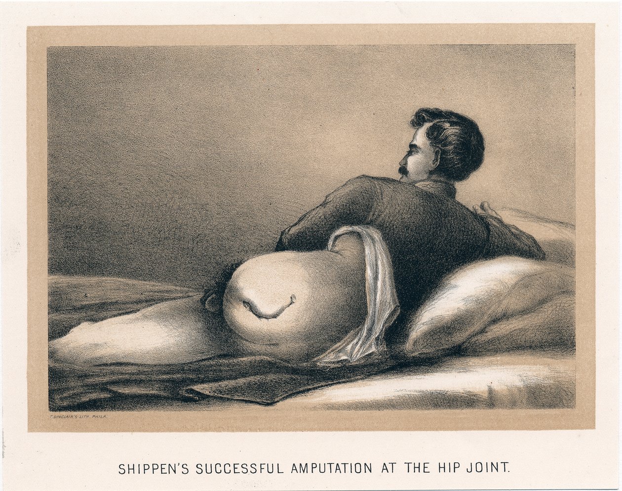 Kalça Ekleminde Başarılı Ampütasyon Gönderiyor, Amerikan İç Savaşı, 1865 by Unbekannt