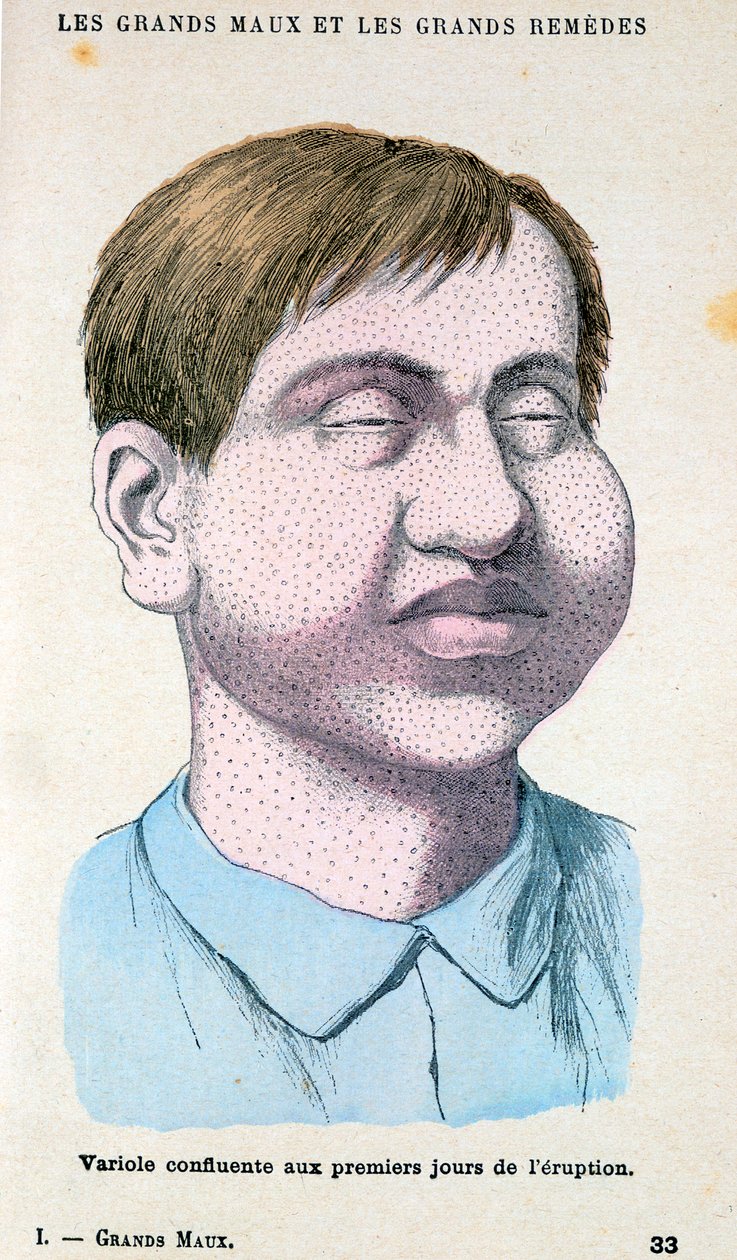 Çiçek hastalığı kurbanı, c1890 by Unbekannt