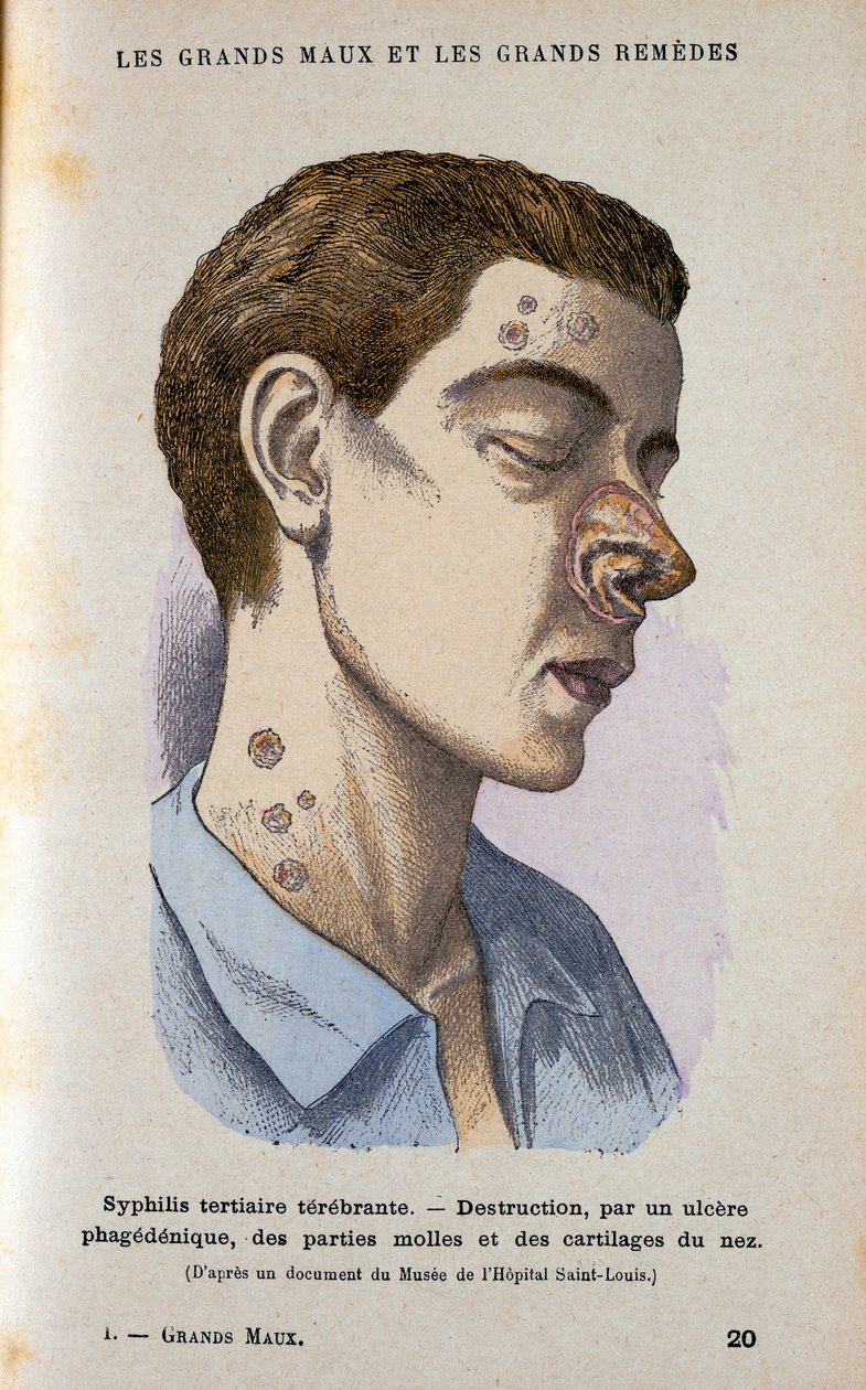 Sifilizin üçüncü evresinin belirtileri, c19. yüzyıl by Unbekannt