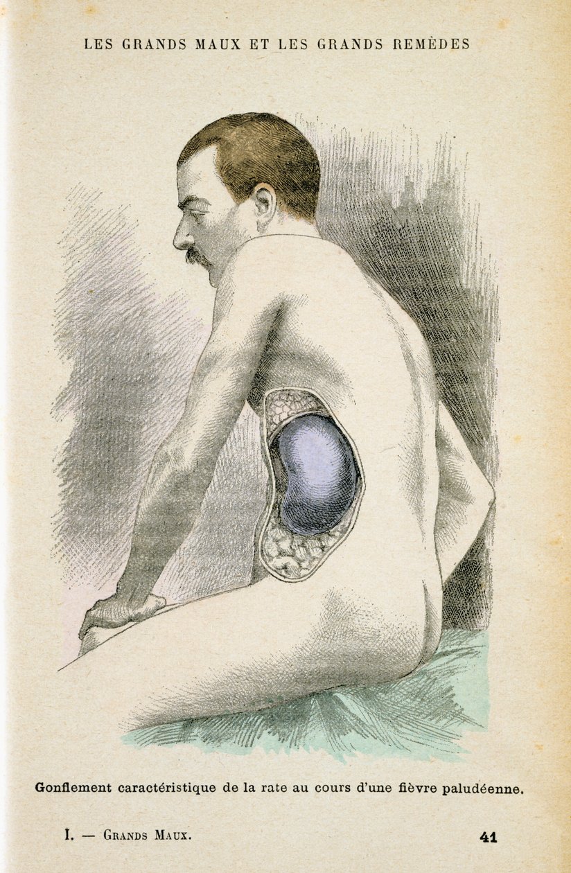 Bir Sıtma hastasının tipik genişlemiş dalağı, c1890 by Unbekannt