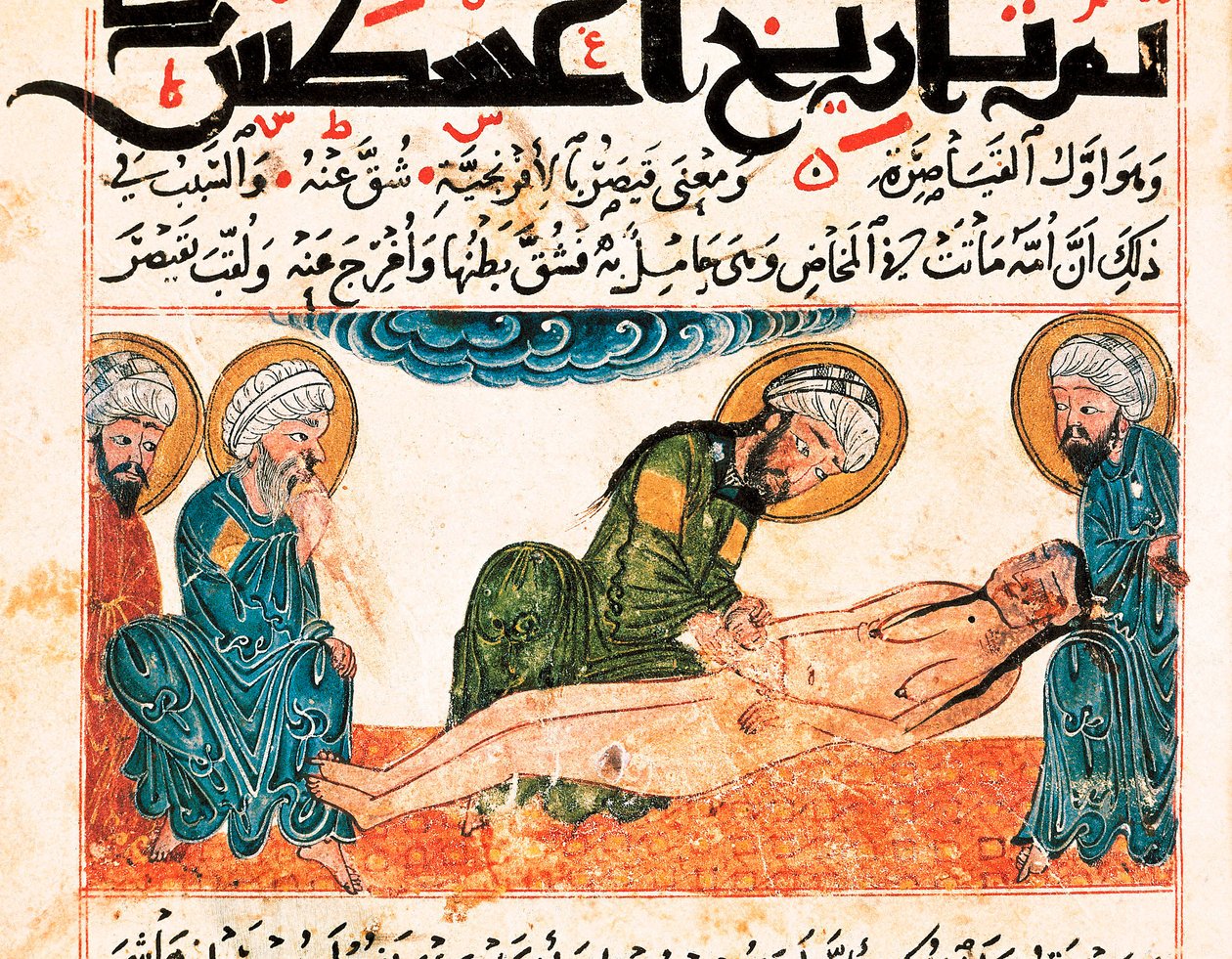 Sezaryen doğumun temsili. Ebu Raihan Al-Biruni (veya Alberuni) (973-1048), İranlı entelektüel ve bilim adamı tarafından bir tıp el yazmasından alınan minyatür, folyo 161. by Unbekannt