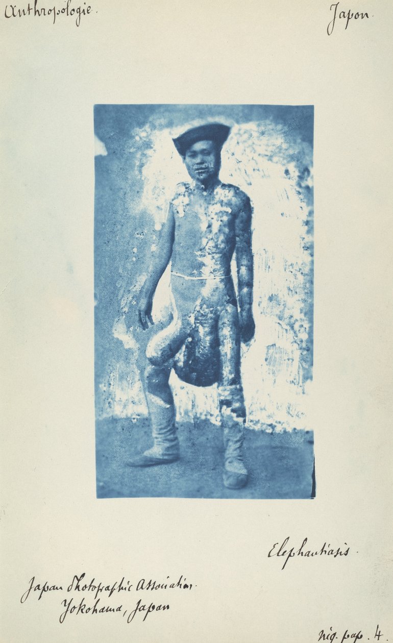 fil hastalığı by Unknown 19th Century