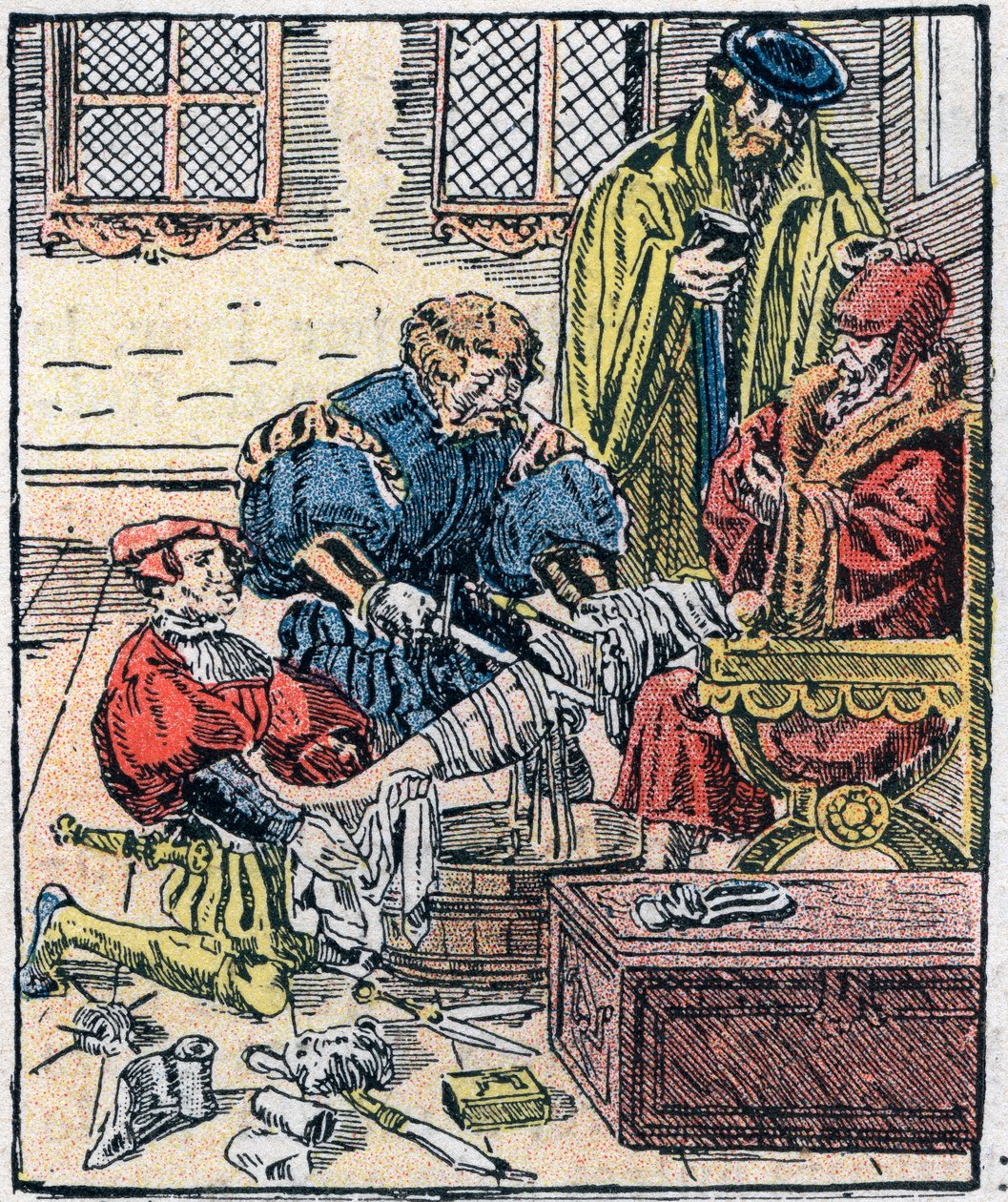 16. yüzyılda bir bacağın amputasyonu. by Unknown artist