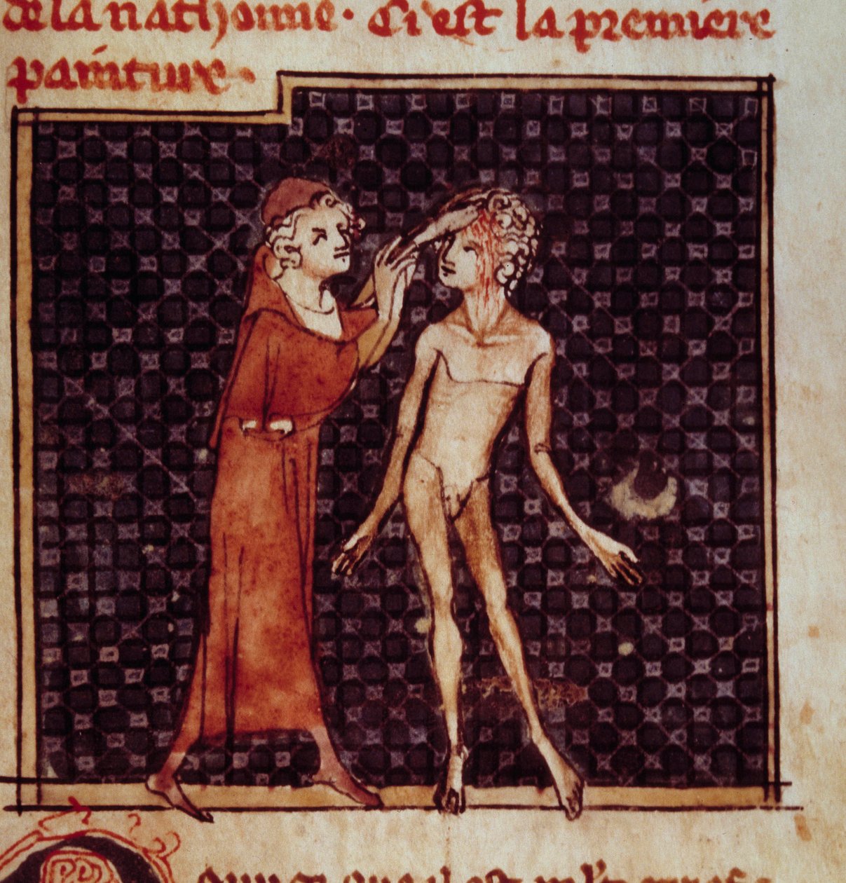 Anatomik Şekil: Cerrah hastanın alnını keser. Henri de Mondeville (Philippe Le Bel