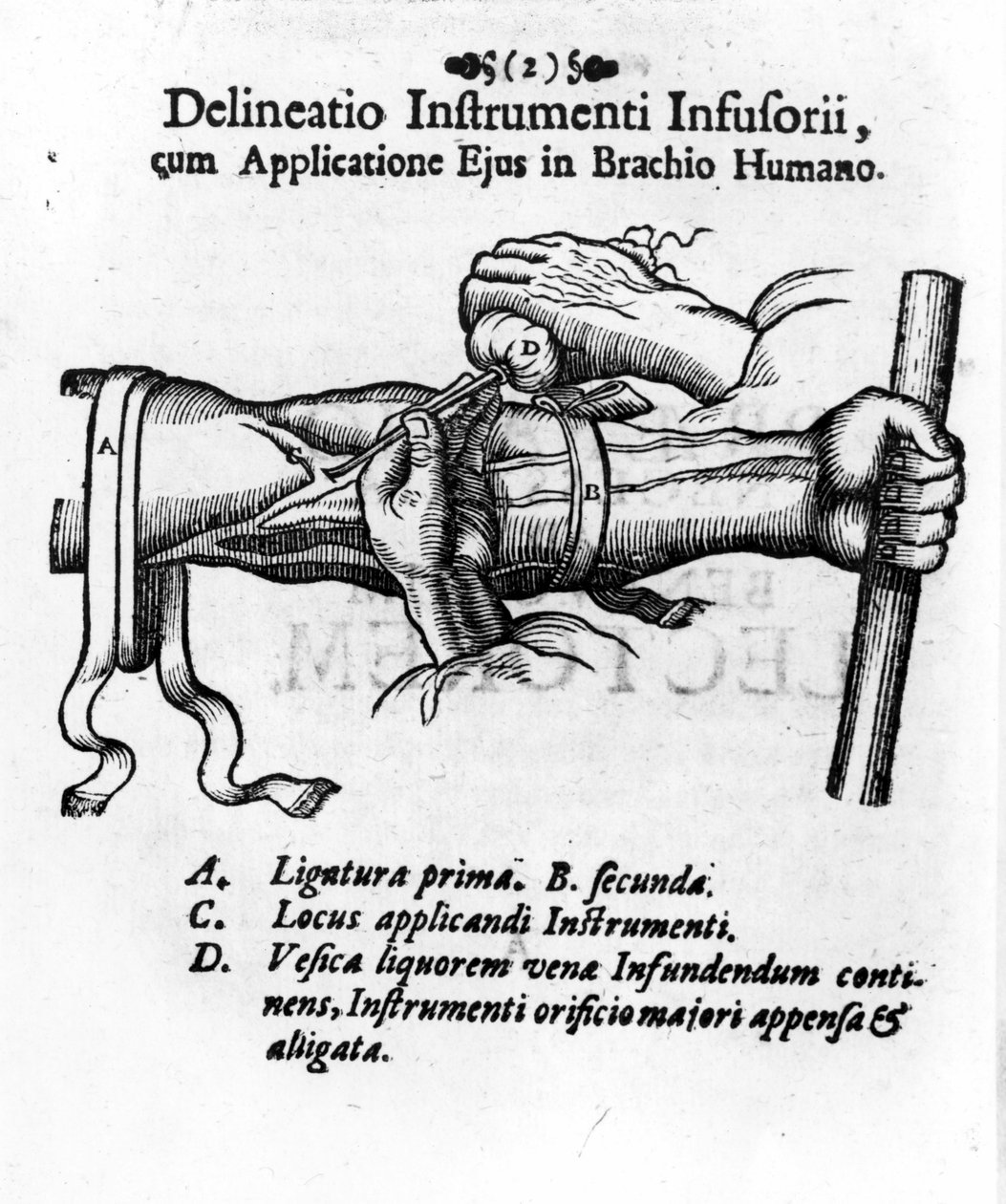 Clystery mesane kullanılarak intravenöz enjeksiyon. JD Mayor tarafından, “” Surgery Infusoria””, Kilonii 1667 by Unknown artist