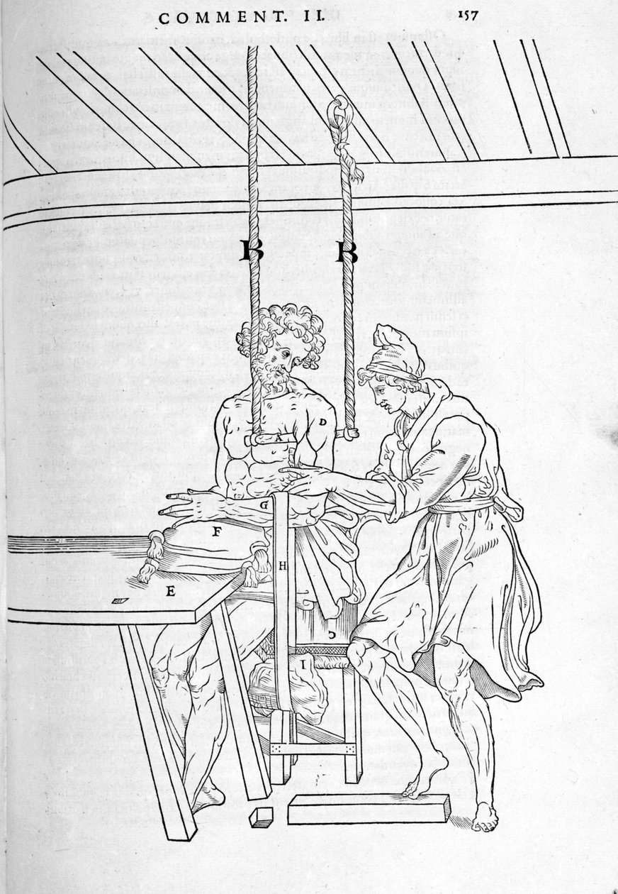 Kırıkların azaltılması. Carlo Stefano Riverio, Paris 1545 tarafından "İnsan vücudunun üç parçaya ayrılması..." resimli levha by Unknown artist