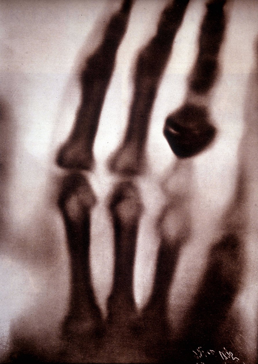 Röntgen ışınları (Röntgen) veya X ışınları İlk fotoğraf: Röntgen