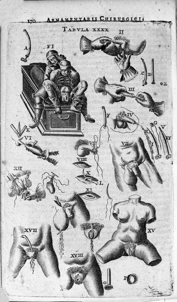Kadın ve erkek cinsiyette cerrahi müdahaleler. J. Scultetus, Venedik