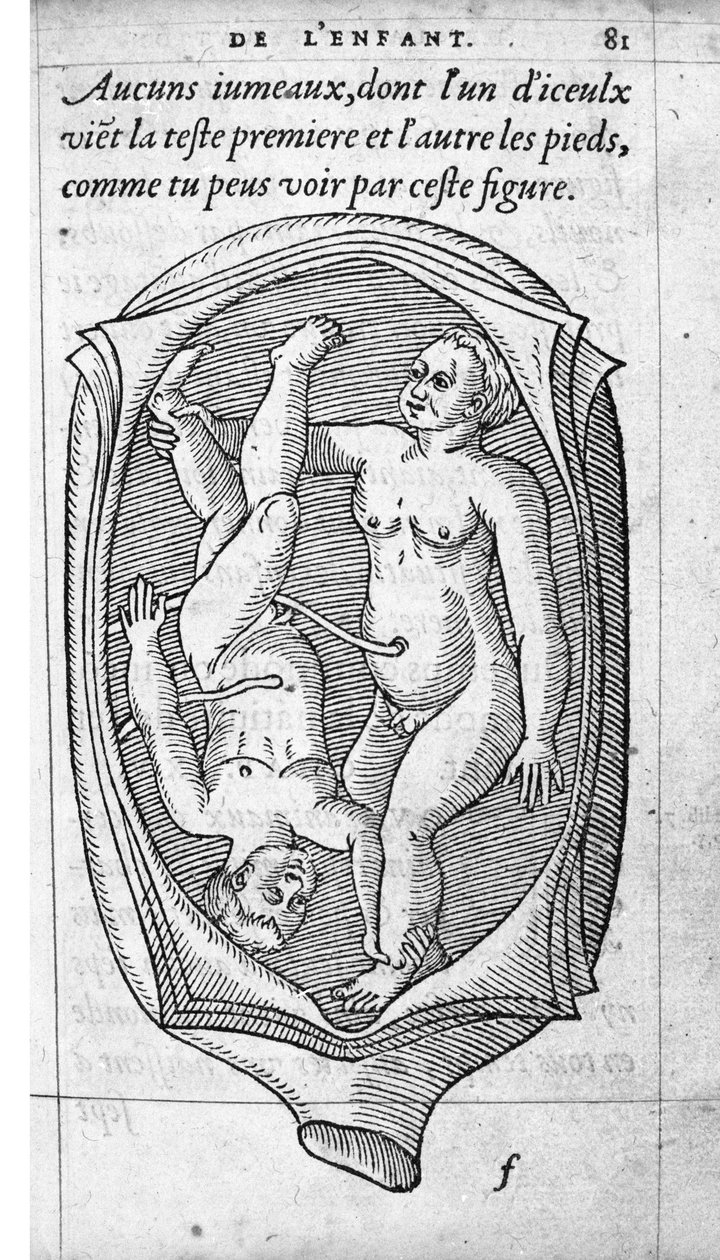 Hamilelik sırasında fetüsün rahimdeki konumu. Fransız doktor ve cerrah Ambroise Pare (1509-1590) tarafından “De la Generation des enfants”dan gravür 16. yüzyıl by Unknown artist