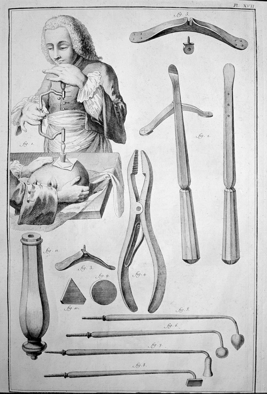 Kafatasının trepanasyonu, çeşitli aletler (gravür by Unknown artist