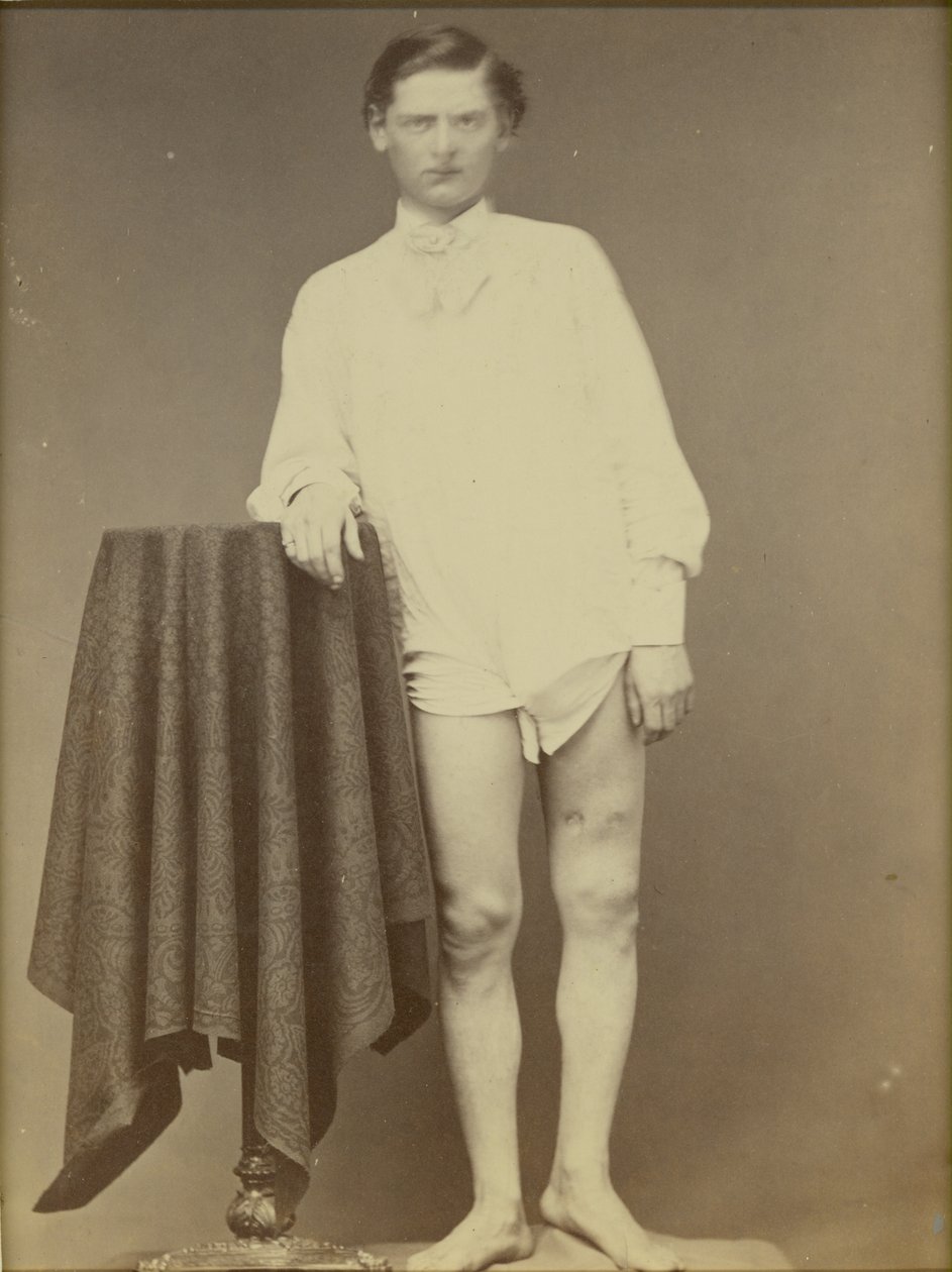 Yaralı İç Savaş Askeri (Private Charles Westerfield, Ordu Tıp Müzesi Numunesi No. 4278), Nisan 1865, 1865 (albüm baskısı) by William Abraham Bell