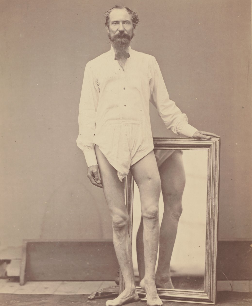 Sol Femurun Orta Üçte Bir Ateşli Silah Yarası, 1865-67. by William H. Bell