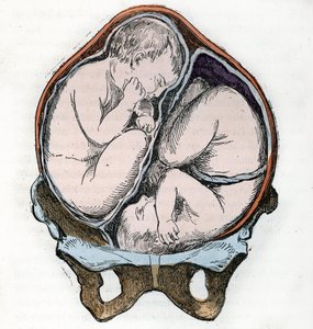 Gemellar gebelik sırasında iki fetüsün iyi pozisyonunun temsili “” La nature et l'homme” Rengade 1881 Özel koleksiyonundan gravür