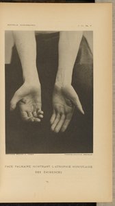  by Albert Londe