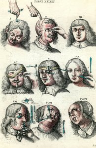 18. yüzyılda cerrahi: Göz ve yüzün trepanasyonu ve operasyonu. Lorenz Heister