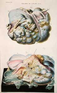 Yumurtalık Hastalıkları, Jean Cruveilhier (1791-1874) 1828-42 (renkli gravür) tarafından 