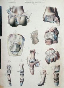 Eklem hastalıkları, Jean Cruveilhier (1791-1874) 1828-42 (renkli gravür) tarafından 