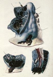 Akciğer hastalıkları, Jean Cruveilhier (1791-1874) 1828-42 (renkli gravür) tarafından 