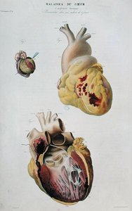 Kalp hastalıklarını gösteren levha. 86 yaşındaki bir kadının kalbinin spontan rüptürü (şekil 1) ve altı günlük bir bebekte perikardit (şekil 2), Jean Cruveilhier (1791-1874), Paris
