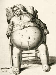 Bir apseden sıvıları boşaltmak, Frederik Dekkers, 1694 by Dutch School