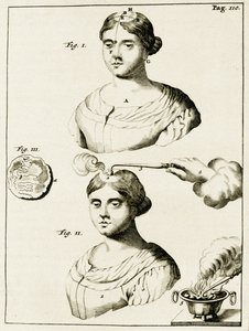 Epilepsi hastasını tedavi etmek, Frederik Dekkers, 1694 tarafından Tıp Uygulamasında Alıştırmalardan by Dutch School