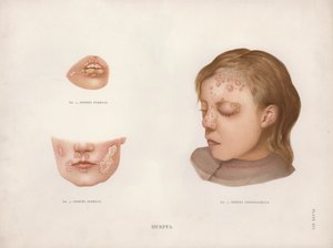 Deri Hastalıkları: Herpes (renkli taş) by English School