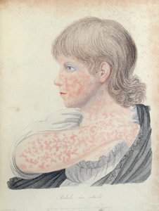 Alman kızamık, Robert Willan (1757-1812) tarafından bir kitap için illüstrasyon, 1808 (renkli gravür) by English School
