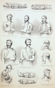 Kırıkların Geçici Tedavisi, c.1890 by English School