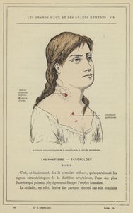İkincil dönemde skrofulozun karakteristik kazaları (renkli taş) by French School