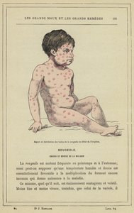 Patlamanın başlangıcında kızamık lekelerinin görünümü ve dağılımı (renkli lito) by French School