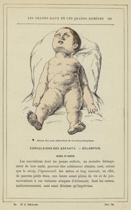 Eklamptik konvülsiyonlu küçük bir çocuğun tutumu (renkli taş) by French School