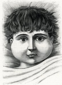 Kabakulak hastalığı olan çocuk (gravür) 1888 by French School