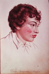 Baron Jean Louis Alibert'in (1768-1837) 'Description des Maladies de la Peau'dan kuru yama by French School
