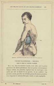 Sıtma ateşi sırasında dalağın karakteristik şişmesi (renkli taş) by French School