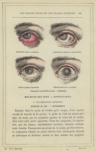 Yüzeysel göz iltihabı, Oftalmi (renkli taş) by French School