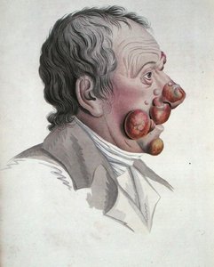 Mikoz Fongoide, Baron Jean Louis Alibert