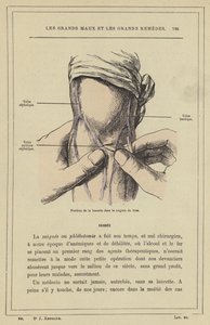 Neşterin kol kanamasındaki konumu (renkli taş) by French School