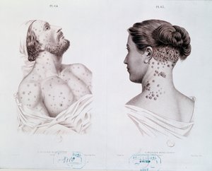Erkeklerde ve kadınlarda frengi belirtileri, bir tıp kitabından, c.1850-60 by French School