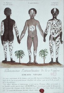 Lökoderma Fenomeni by French School