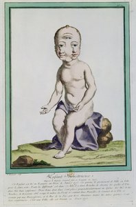 Başı Deforme Olan Çocuk, 