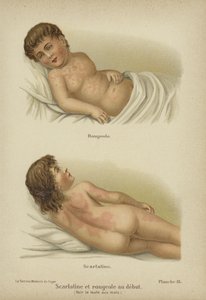 Kızamık ve kızıl hastalığının erken belirtileri (renk litosu) by German School