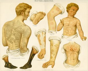 Cilt bozuklukları, c.1890 by German School